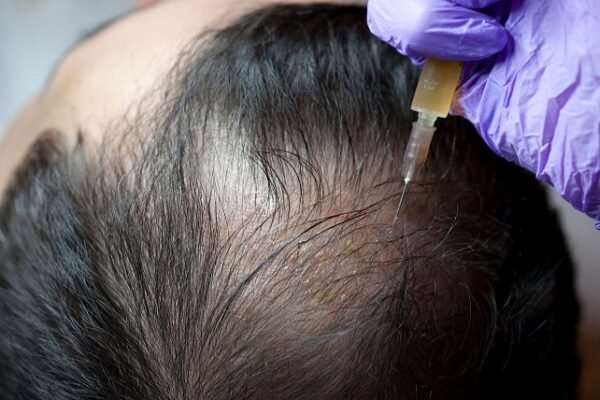 PRP Treatment for Hair Loss